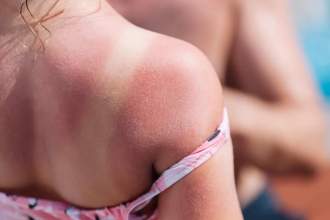 child-s-sunburned-shoulder-at-the-beach-2026-01-07-06-04-25-utc